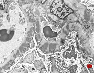 M,20y. | membranous glomerulopathy